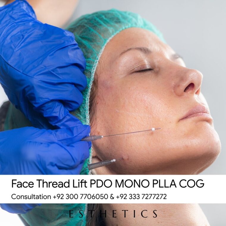 Face Thread Lift PDO PLLA COG Aptos Tesslift