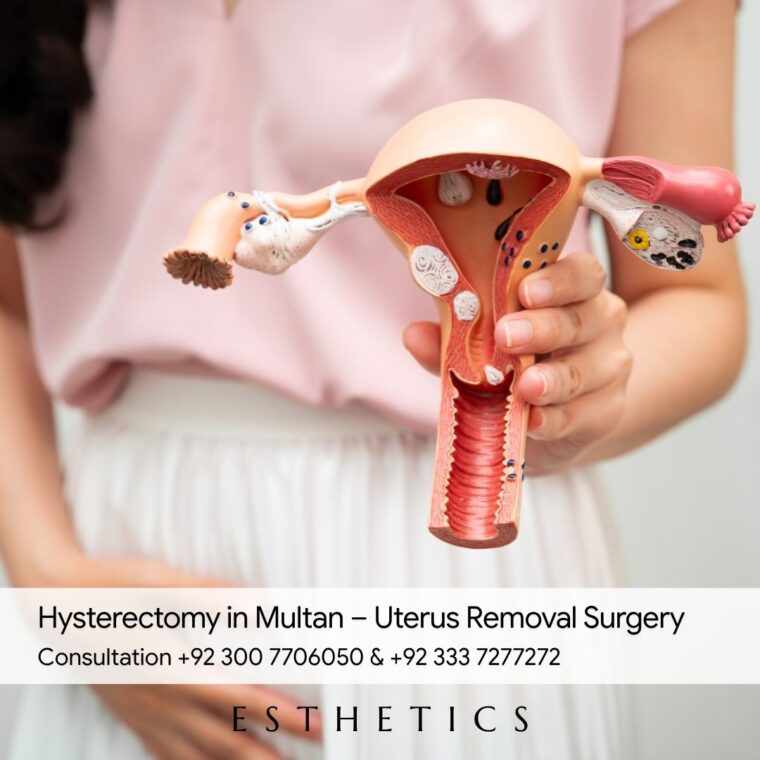Hysterectomy in Multan
