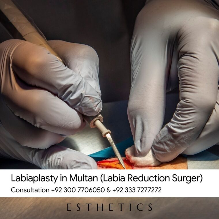 Labiaplasty in Multan